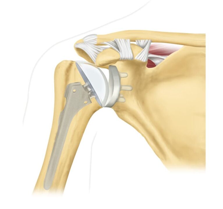 Zëvendësimi i një nyjeje të dëmtuar të shpatullës me një endoprotezë