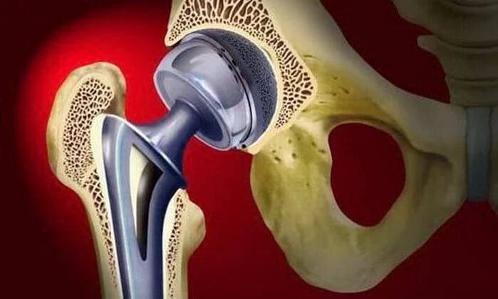 Zëvendësimi i nyjeve të hipit për artrozë