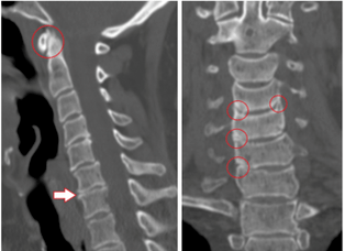 Skanimi CT tregon rruaza dhe disqe të dëmtuara me lartësi heterogjene për shkak të osteokondrozës torakale. 