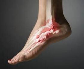 artroza e kyçit të këmbës