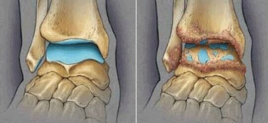 artroza të shëndetshme të kyçeve dhe kyçit të këmbës