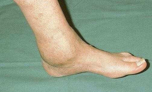 ënjtje e kyçit të këmbës me artrozë