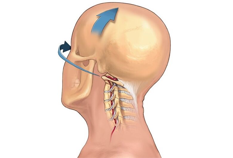 kërcitja e qafës kur kthen kokën si simptomë e osteokondrozës së qafës së mitrës