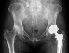 Diagnoza e artrozës së kyçit të hip